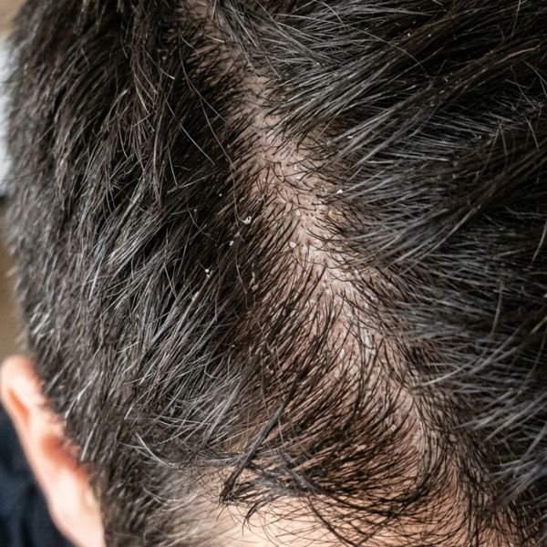 Caspa ou couro cabeludo seco: como distinguir?